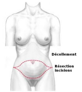 Abdominoplastie Tunisie