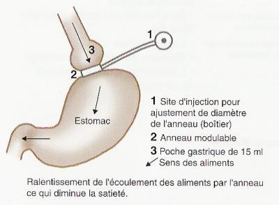 Anneau gastrique - Chirurgiedirect