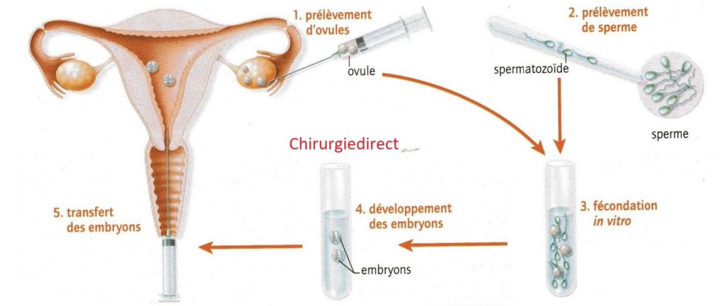 Procréation Médicalement Assistée