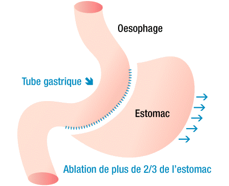 Sleeve gastrectomie