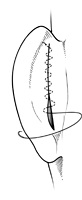 La technique chirurgicale de l’otoplastie