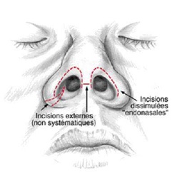 Rhinoplastie en Tunisie Types d'incisions