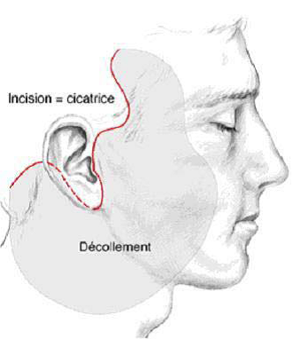 Lifting cervico-facial Tunisie