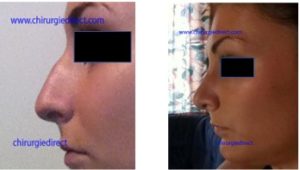 résultat de rhinoplastie