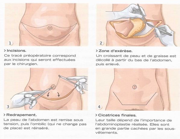 Abdominoplastie Tunisie