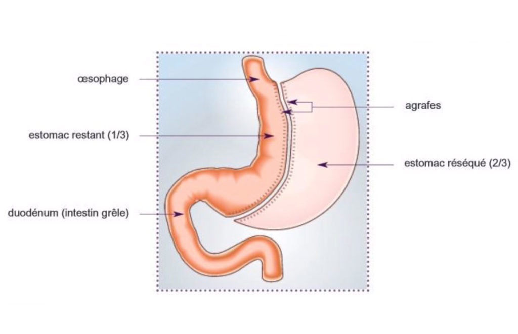 video-chir-obesite